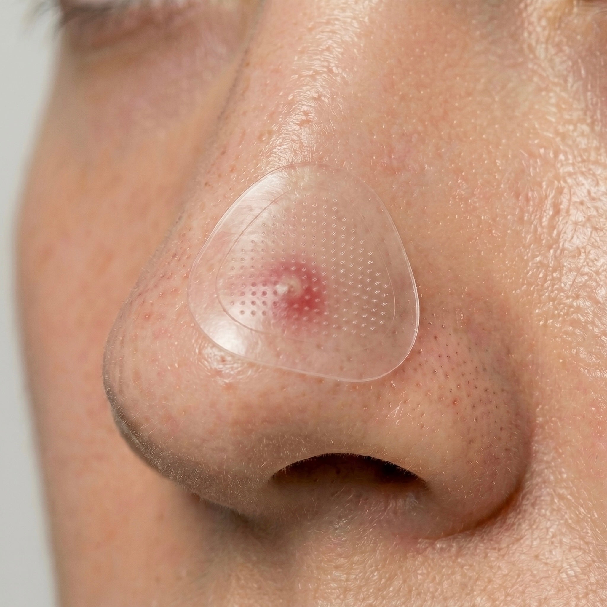 Redness Relief Hydrocolloid Patches