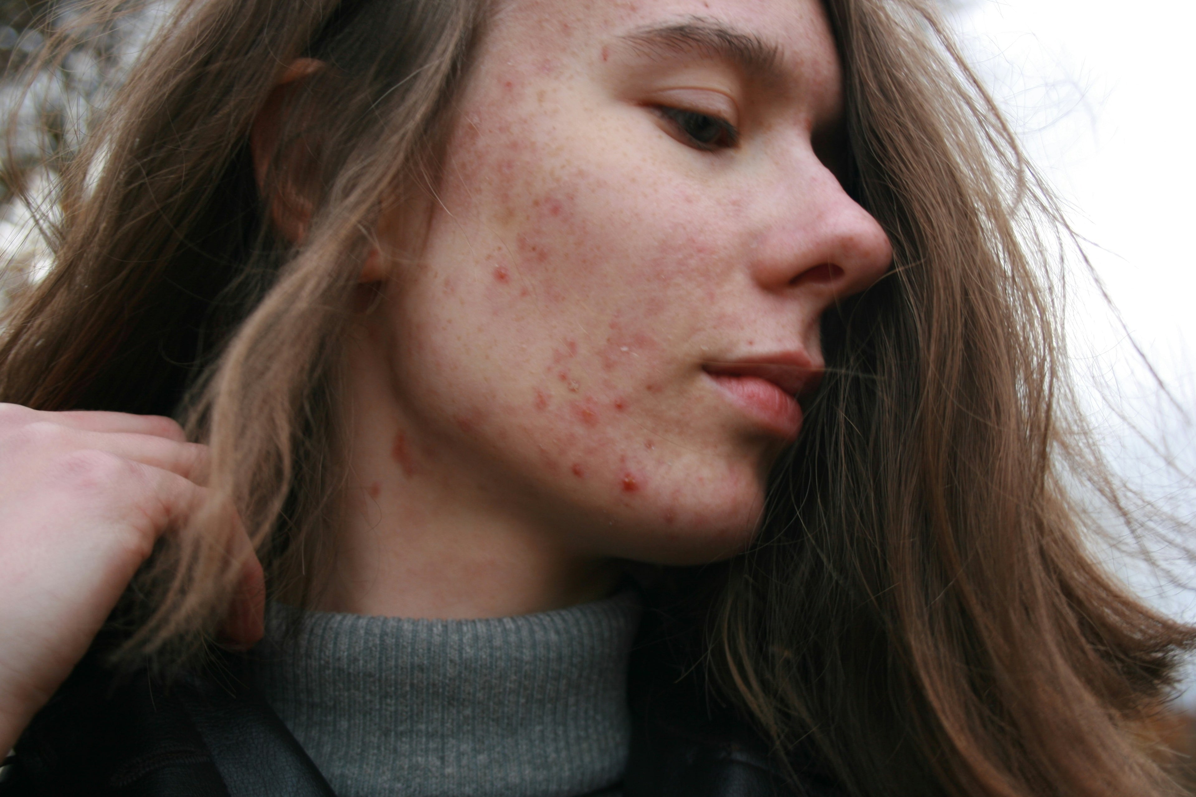 Advanced Acne Scar Repair Cream